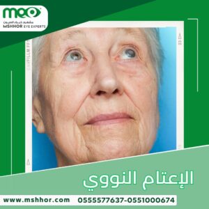 إعتام عدسة العين 