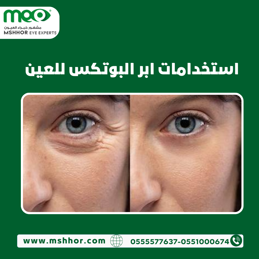 استخدامات ابر البوتكس للعين