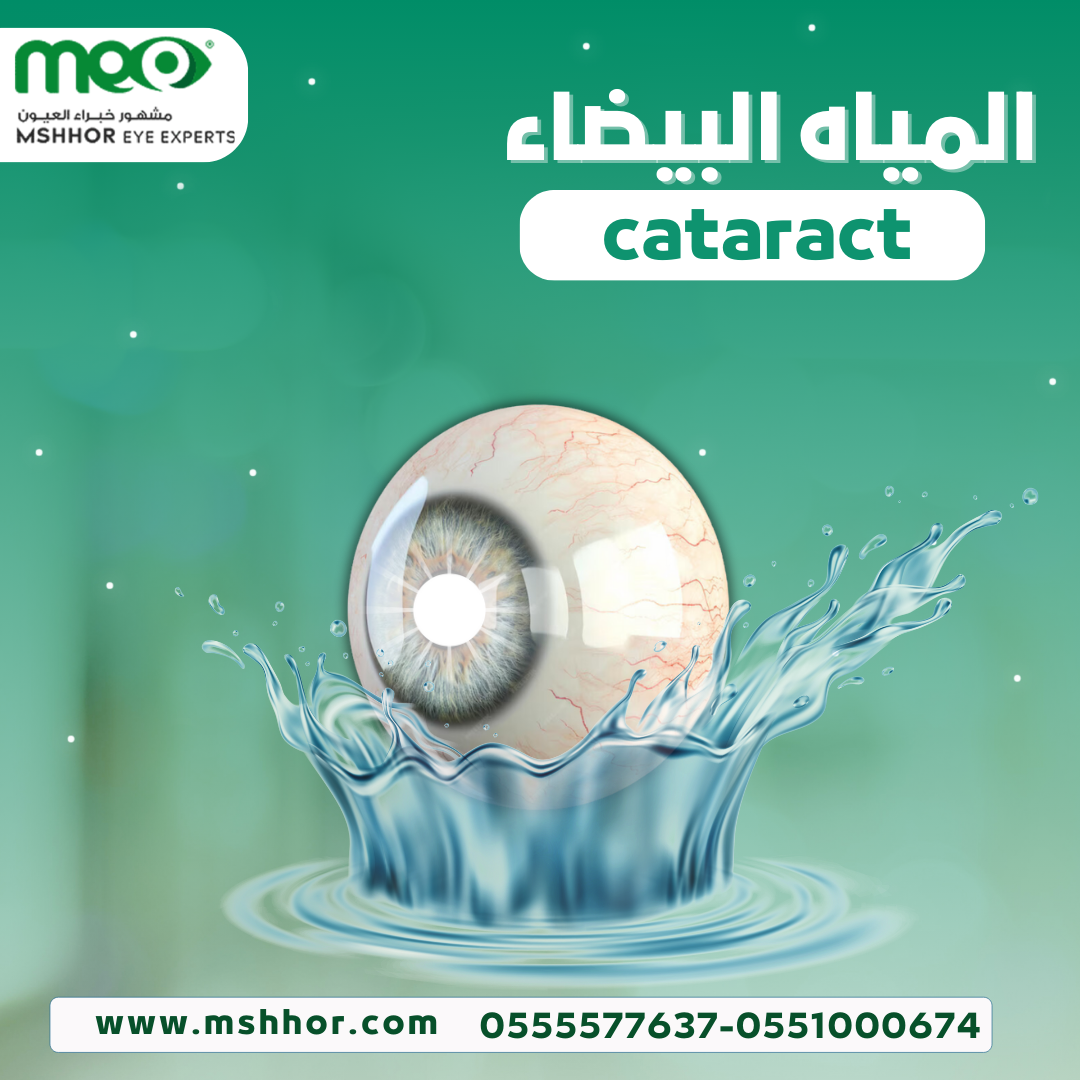 المياه البيضاء cataract