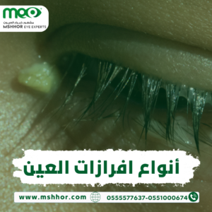 أنواع افرازات العين