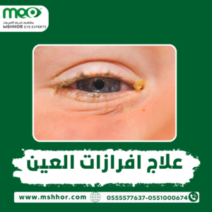علاج افرازات العين
