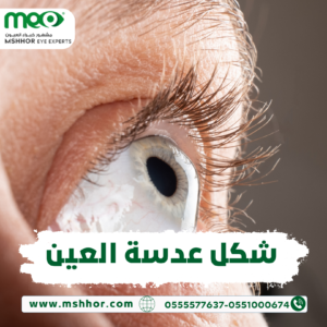 شكل عدسة العين