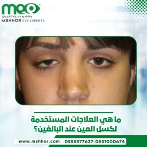 كسل العين عند البالغين