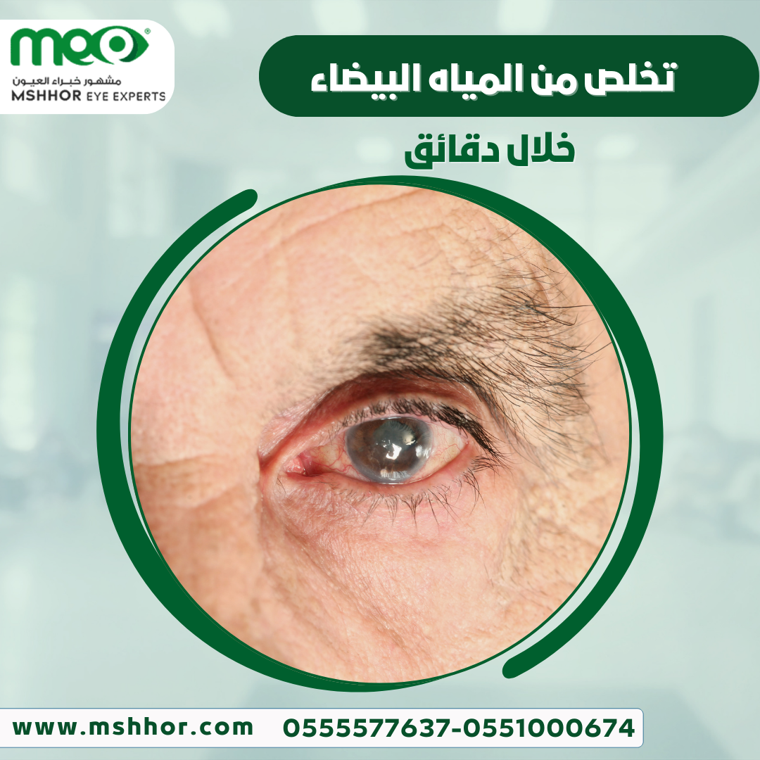 علاج المياه البيضاء في العين