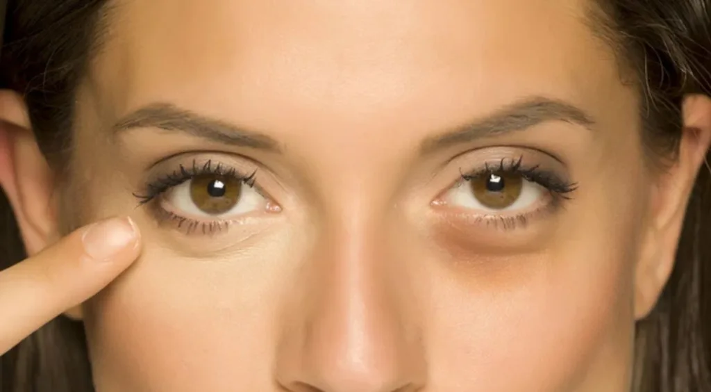 انتفاخ تحت العين