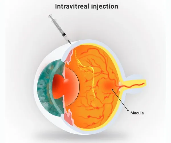 حقن العين لعلاج الشبكية