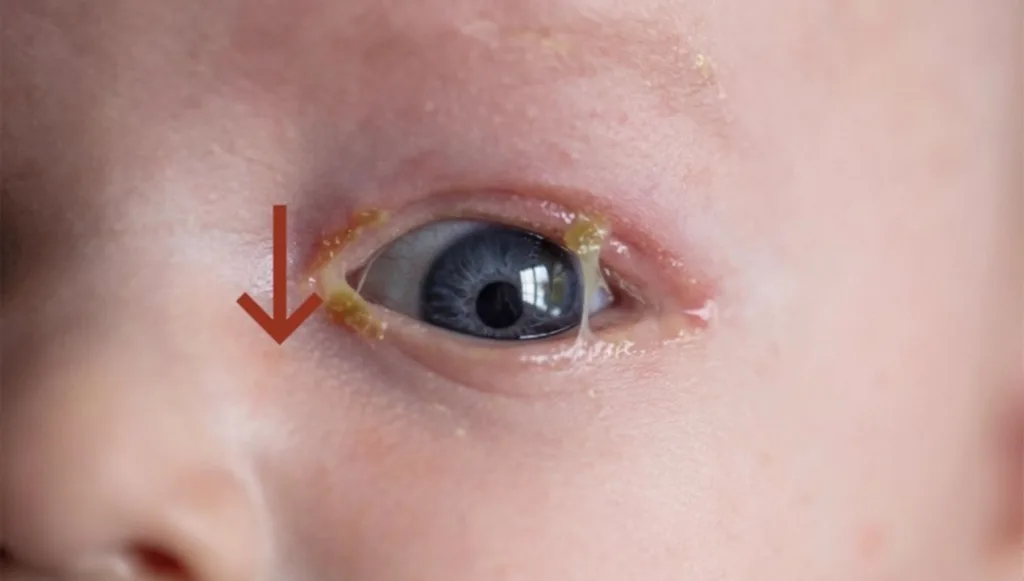 انسداد القناة الدمعية