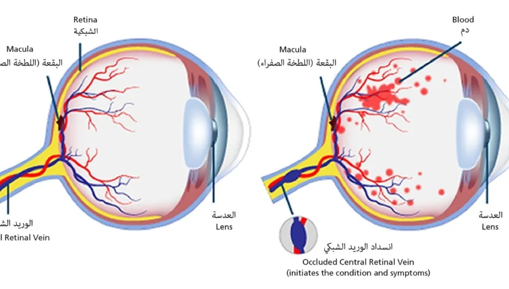 انسداد الوريد الشبكي