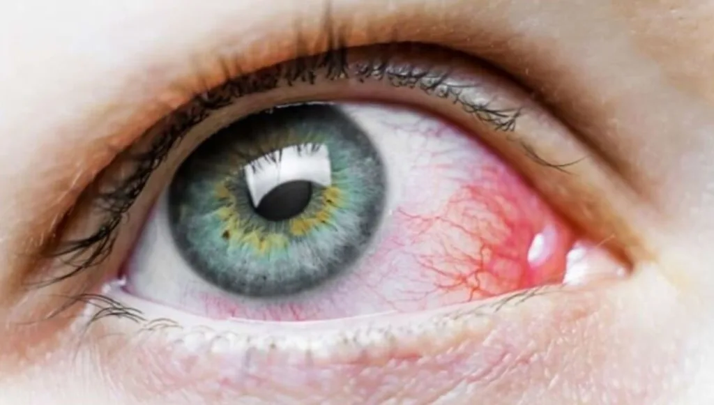 الفطر الاسود في العين