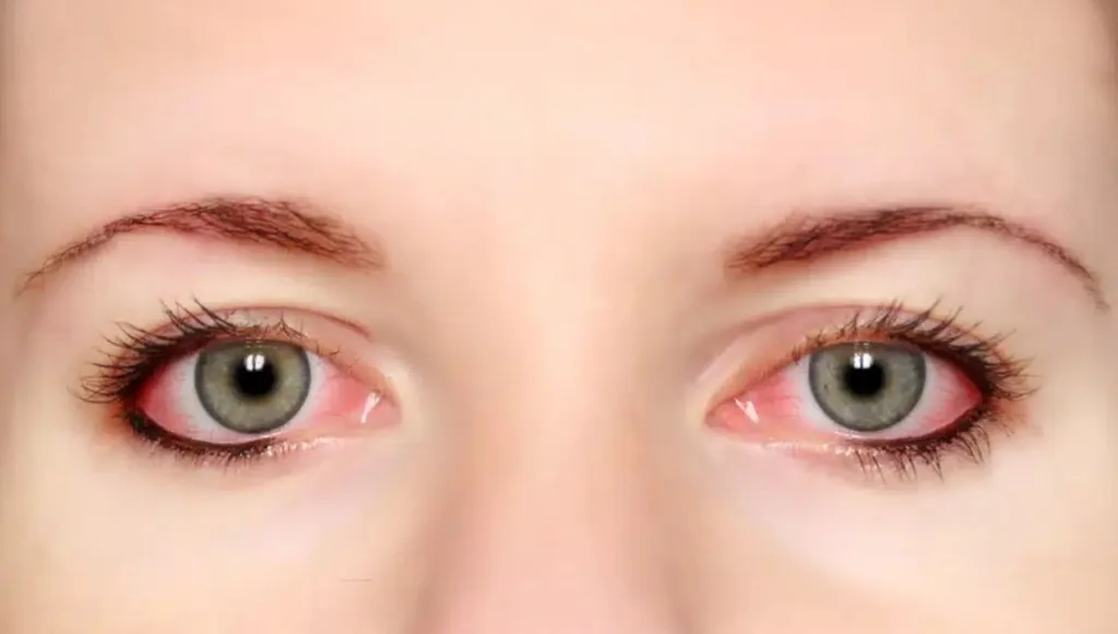 الفرق بين التهاب العين الفيروسي والبكتيري