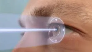 علاج الاستجماتيزم بالليزك