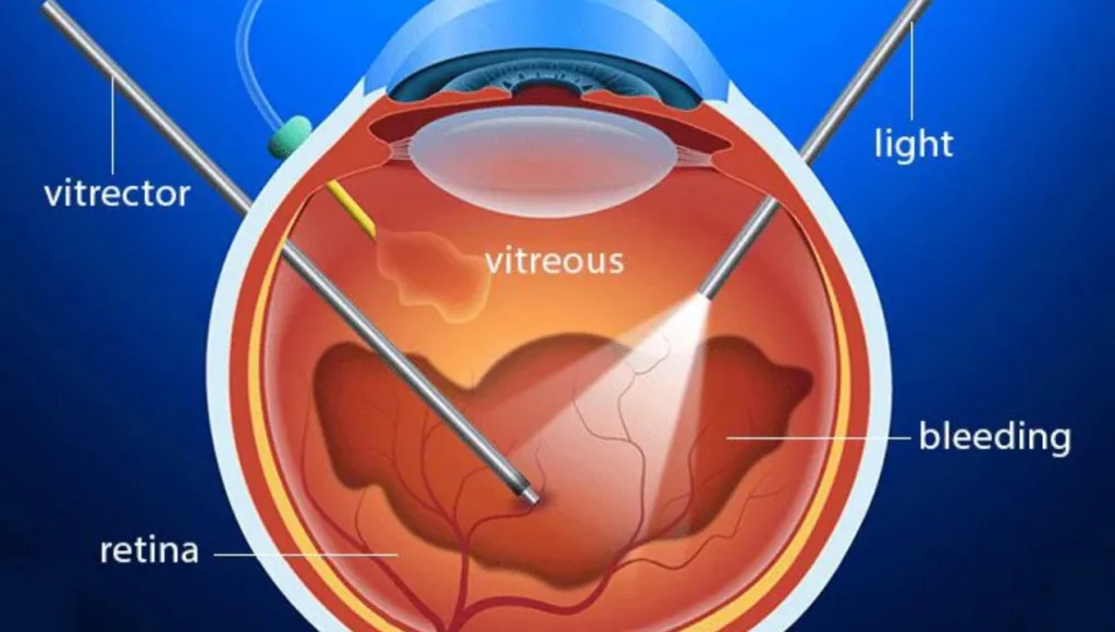 نزيف الشبكية