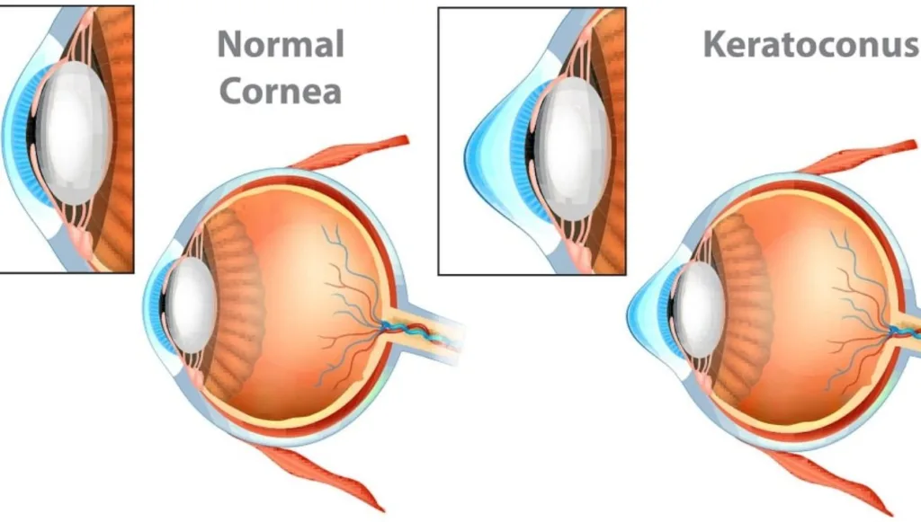 هل القرنية المخروطية تسبب العمى