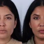 عملية شد الجفون