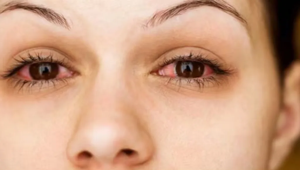 التهاب الملتحمة التحسسي