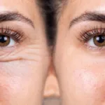 جراحة العيون التجميلية