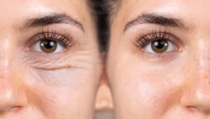 جراحة العيون التجميلية