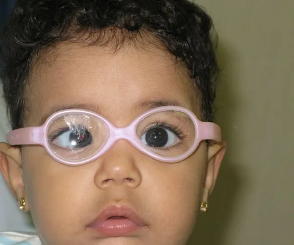 سبب حول العين المفاجئ عند الاطفال