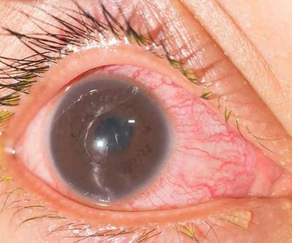 التهاب قزحية العين