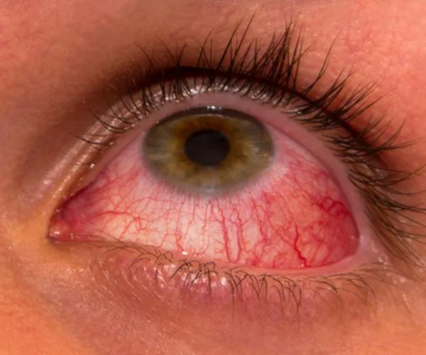 التهاب قزحية العين