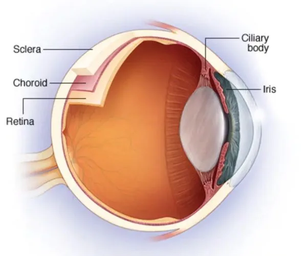 التهاب قزحية العين