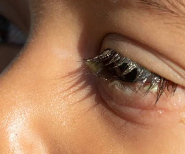 علاج افرازات العين