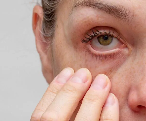 علاج افرازات العين