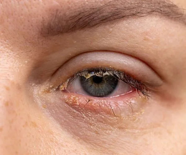 علاج افرازات العين