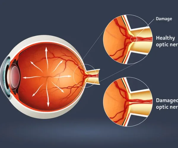 عملية المياه الزرقاء