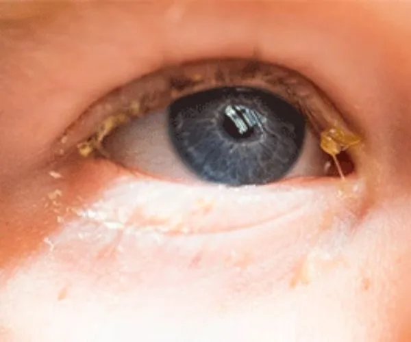 انواع افرازات العين