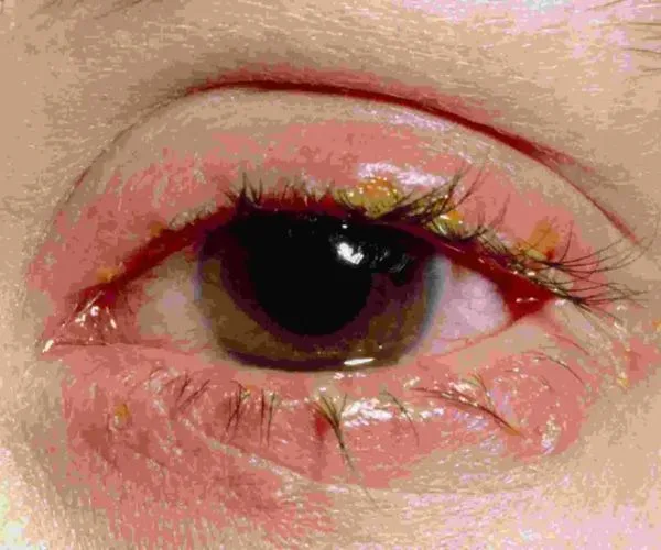 انواع افرازات العين