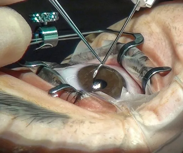 هل عملية المياه الزرقاء خطيرة