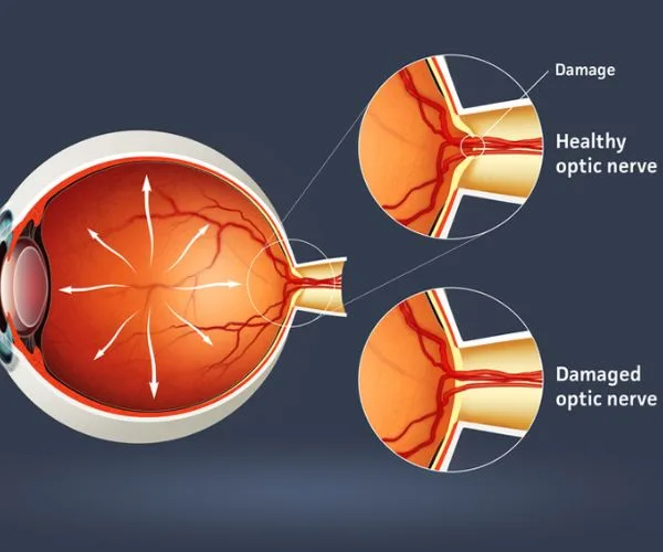 هل عملية المياه الزرقاء خطيرة