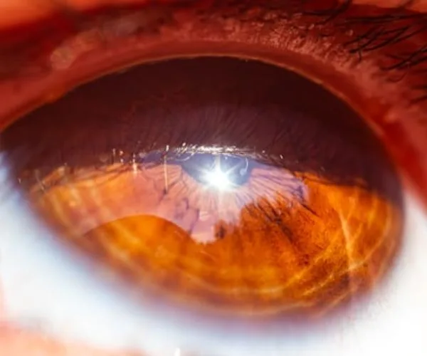 مضاعفات عملية المياه الزرقاء