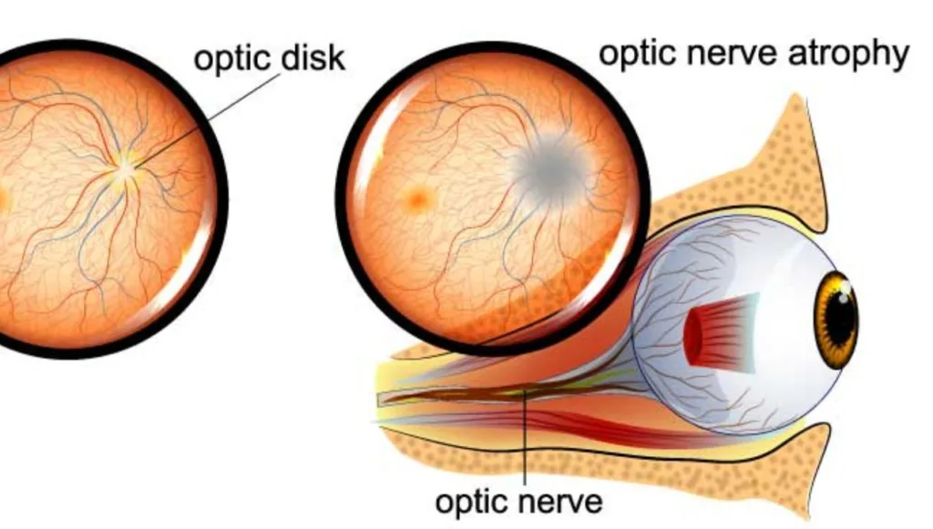 ضمور العصب البصري
