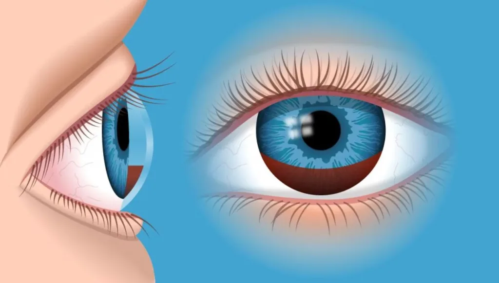 اسباب نزيف العين