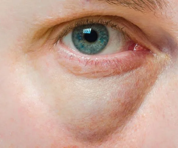 انتفاخ جفن العين السفلي