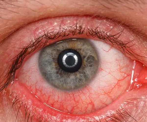 تجربتي مع انفصال الشبكية