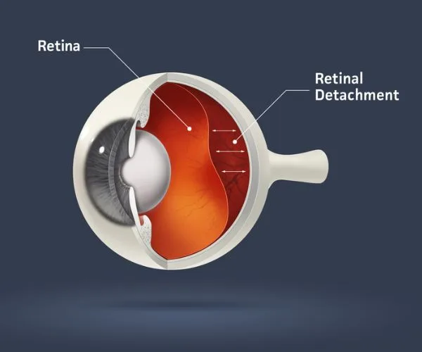تجربتي مع انفصال الشبكية