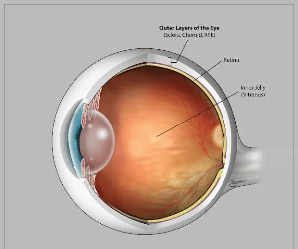 تجربتي مع انفصال الشبكية
