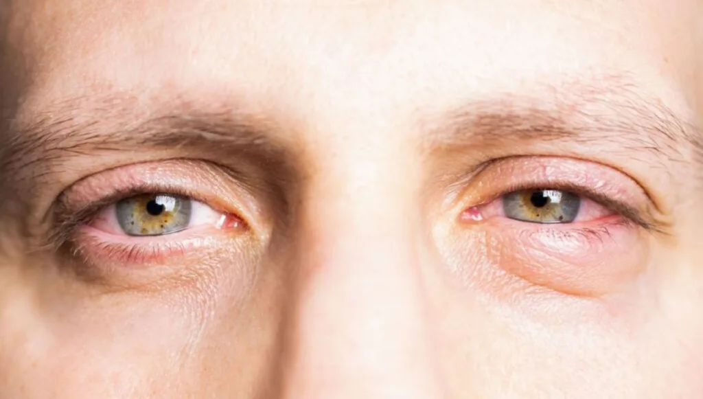 انتفاخ جفن العين السفلي