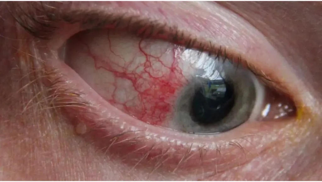 ظهور عروق حمراء في العين