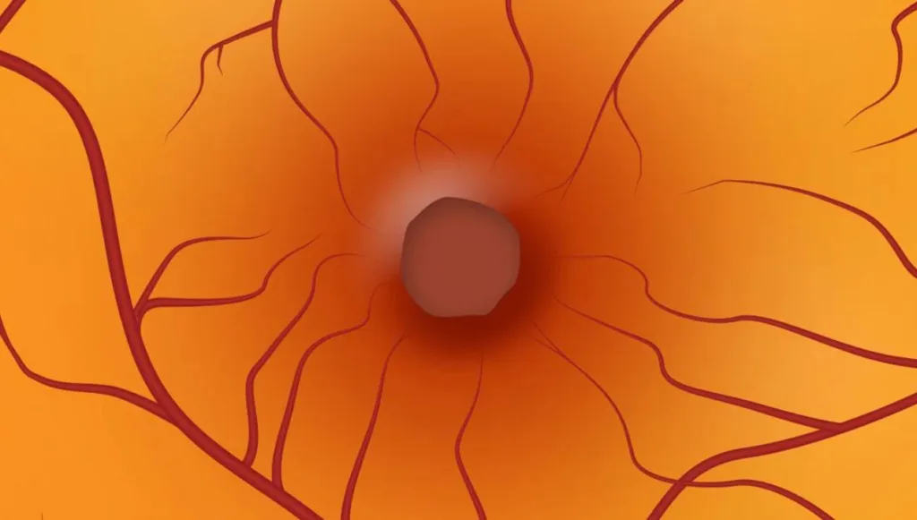 اسباب ثقب شبكية العين