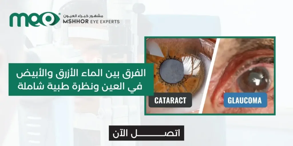 الفرق بين الماء الازرق والابيض في العين