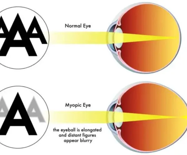 قصر النظر الكاذب