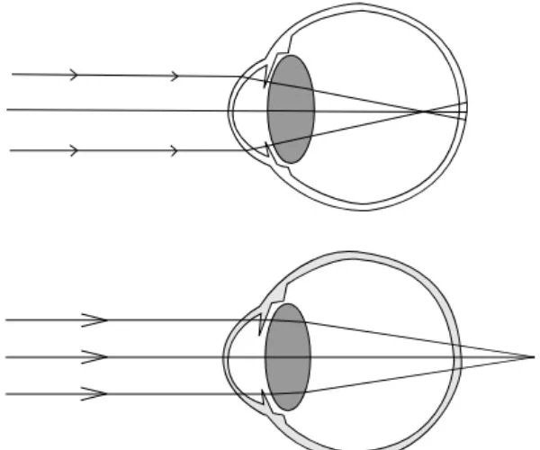 قصر النظر الكاذب