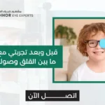 تجربتي مع عملية الحول