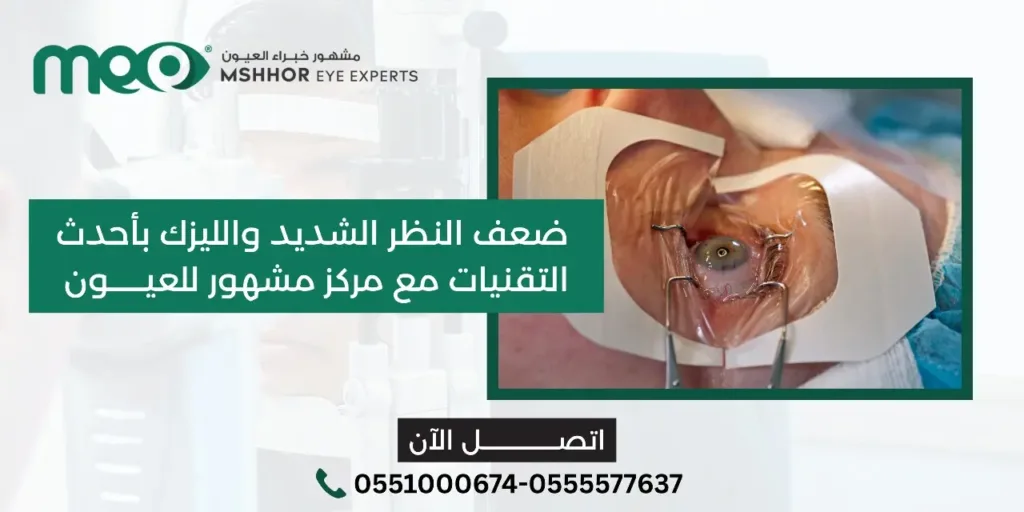 ضعف النظر الشديد والليزك