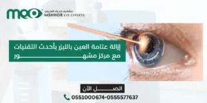 إزالة عتامة العين بالليزر