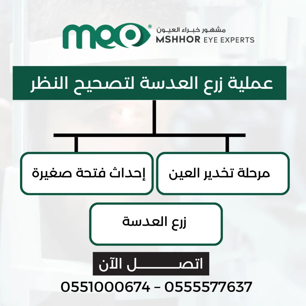 العدسات الدائمة لتصحيح النظر